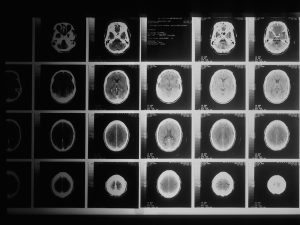 Câncer cabeça Raio-X exame National Cancer Institute Unsplash