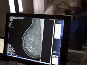 mamografia exame josé cruz agência Brasil