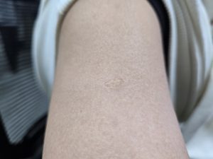 Vacina Braço Marca BCG