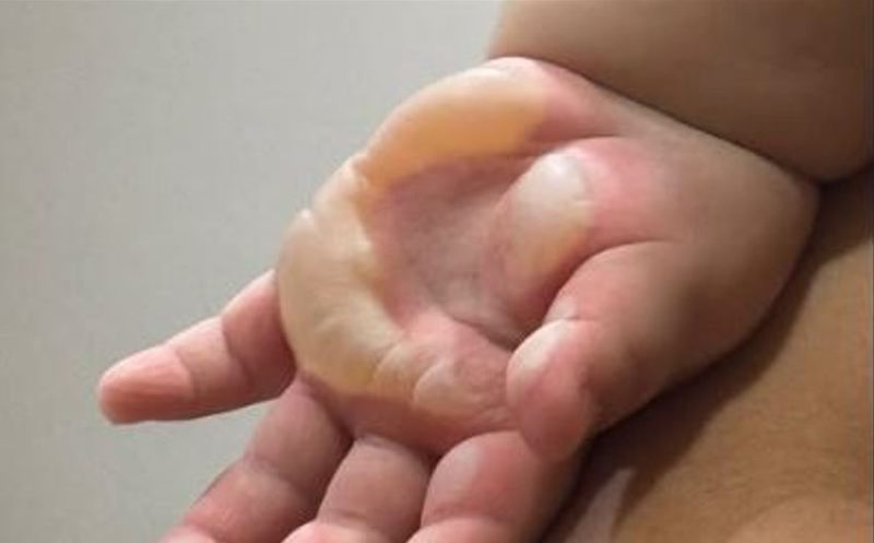 Filho de Viih Tube é internado após sofrer queimaduras de segundo grau