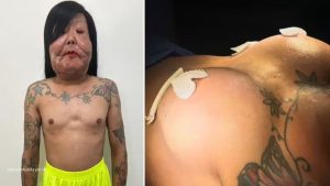 Influenciadora Juju do Pix em destaque sobre cirurgia de retirada de óleo mineral e novos implantes de silicone.