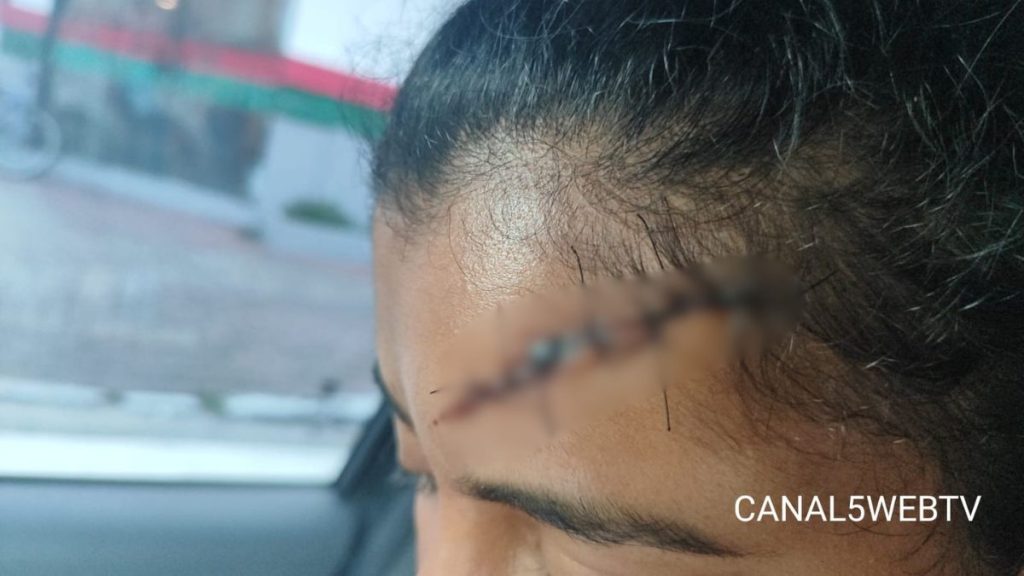 Rayssa Pires Faria com ferimento na testa causado por agressão com pedaço de madeira durante ataque sofrido em Praia Grande.