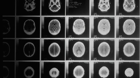 Câncer cabeça Raio-X exame National Cancer Institute Unsplash