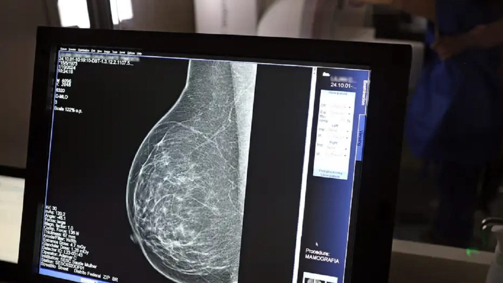 mamografia exame josé cruz agência Brasil