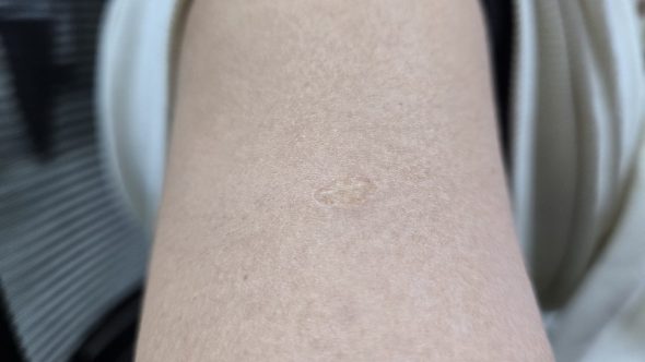 Vacina Braço Marca BCG